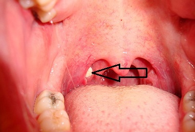are tonsil stones contagious